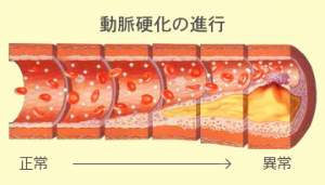 arteriosclerosis